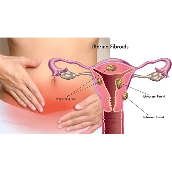 Uterine Fibroids: Types, Symptoms, Risk Factors & Treatment
